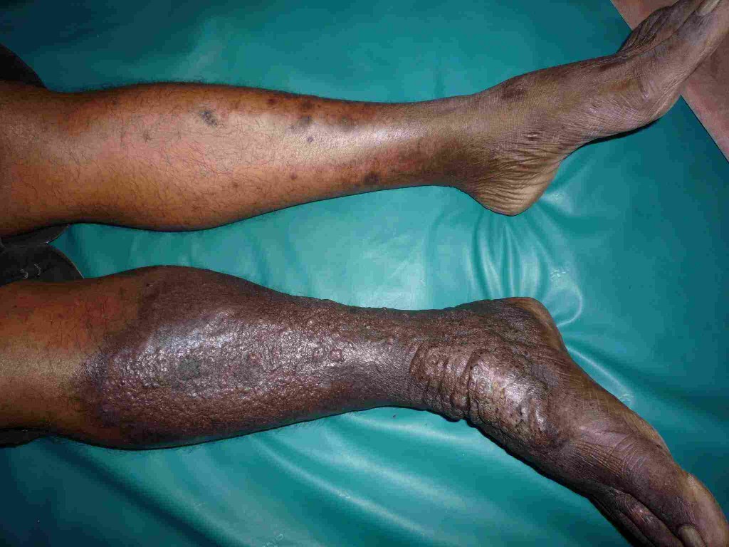 eczema on feet #9